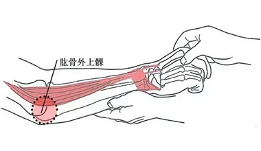 什么是肱骨外上髁炎？多(duō)发于那些人群？