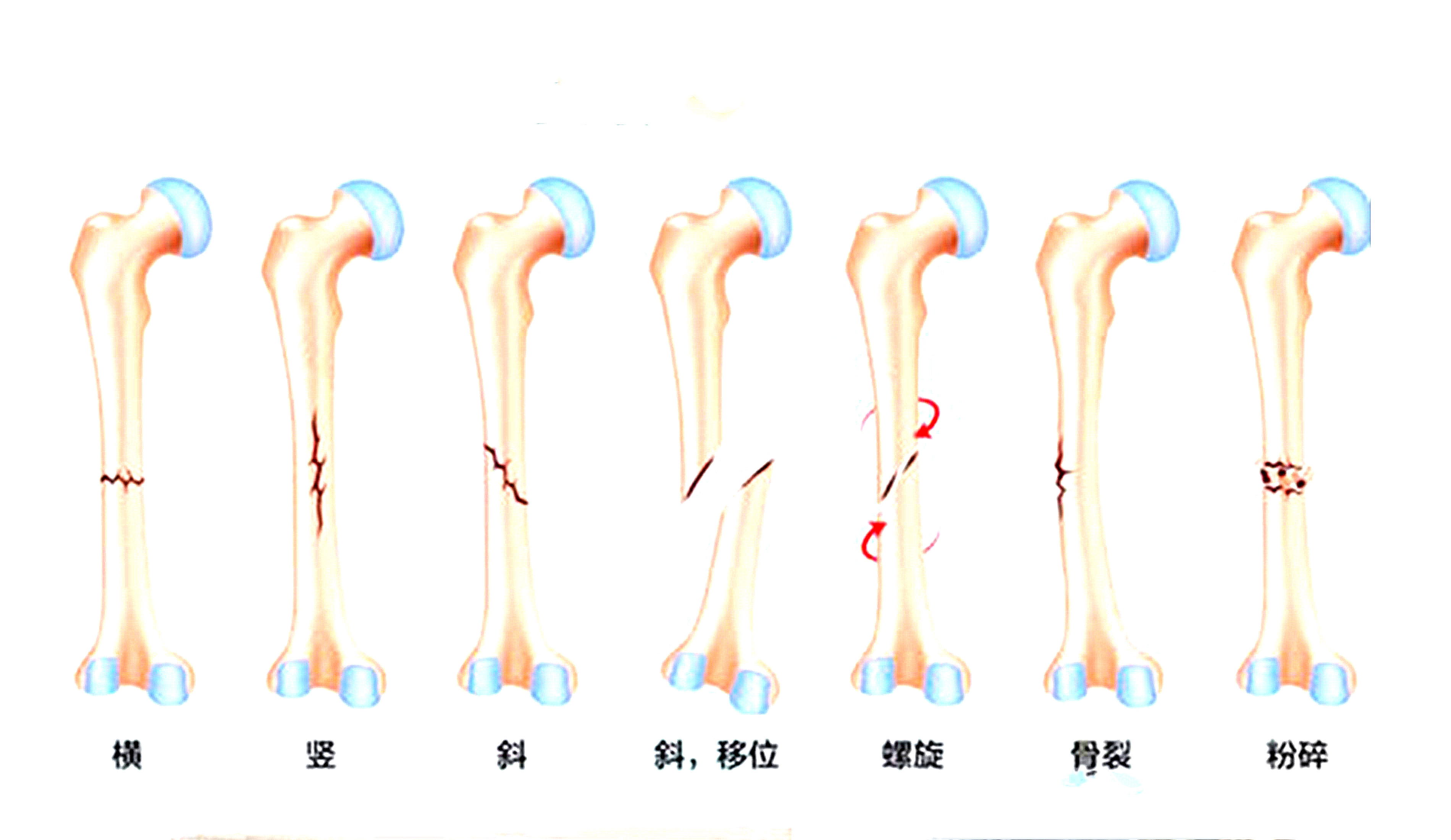 骨裂是骨折吗？